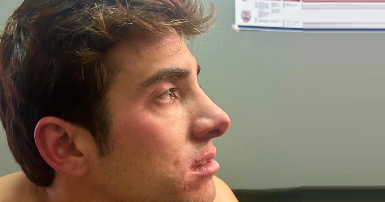 La imagen impactante de Cristian Garín tras el golpazo sufrido en la Copa Davis