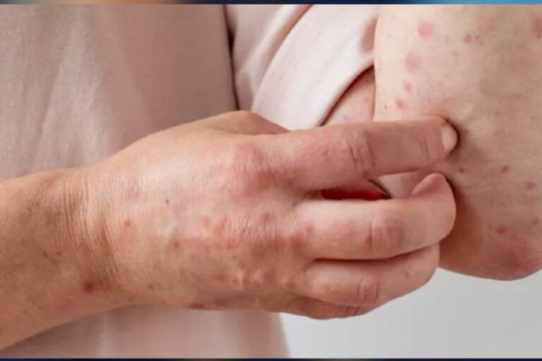 Todo lo que tenés que saber sobre el Sarampión en 2025